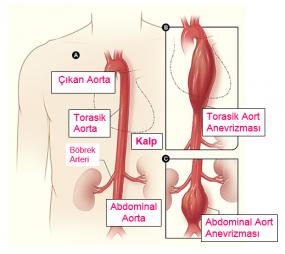 aort anevrizması ve yüksek tansiyon
