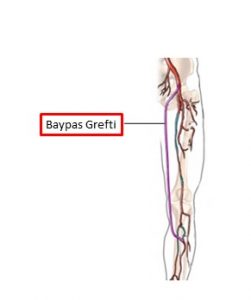 Bacak Damar Tıkanıklığı (PAH): Belirtileri ve Tedavi Seçenekleri