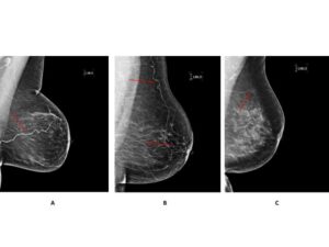 Kadınlarda Kalp Hastalığının erken tanısında Mamografinin rolü