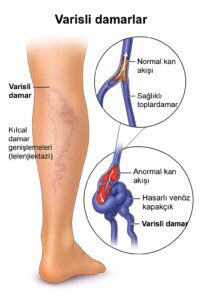 Varis Nedir? Belirtileri, Nedenleri ve Etkili Tedavi Yöntemleri
