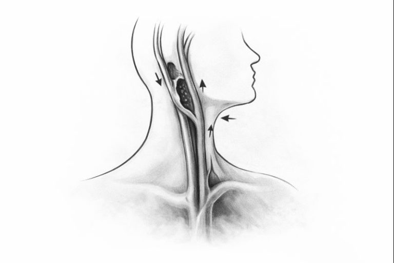 Şah Damar Tıkanıklığı