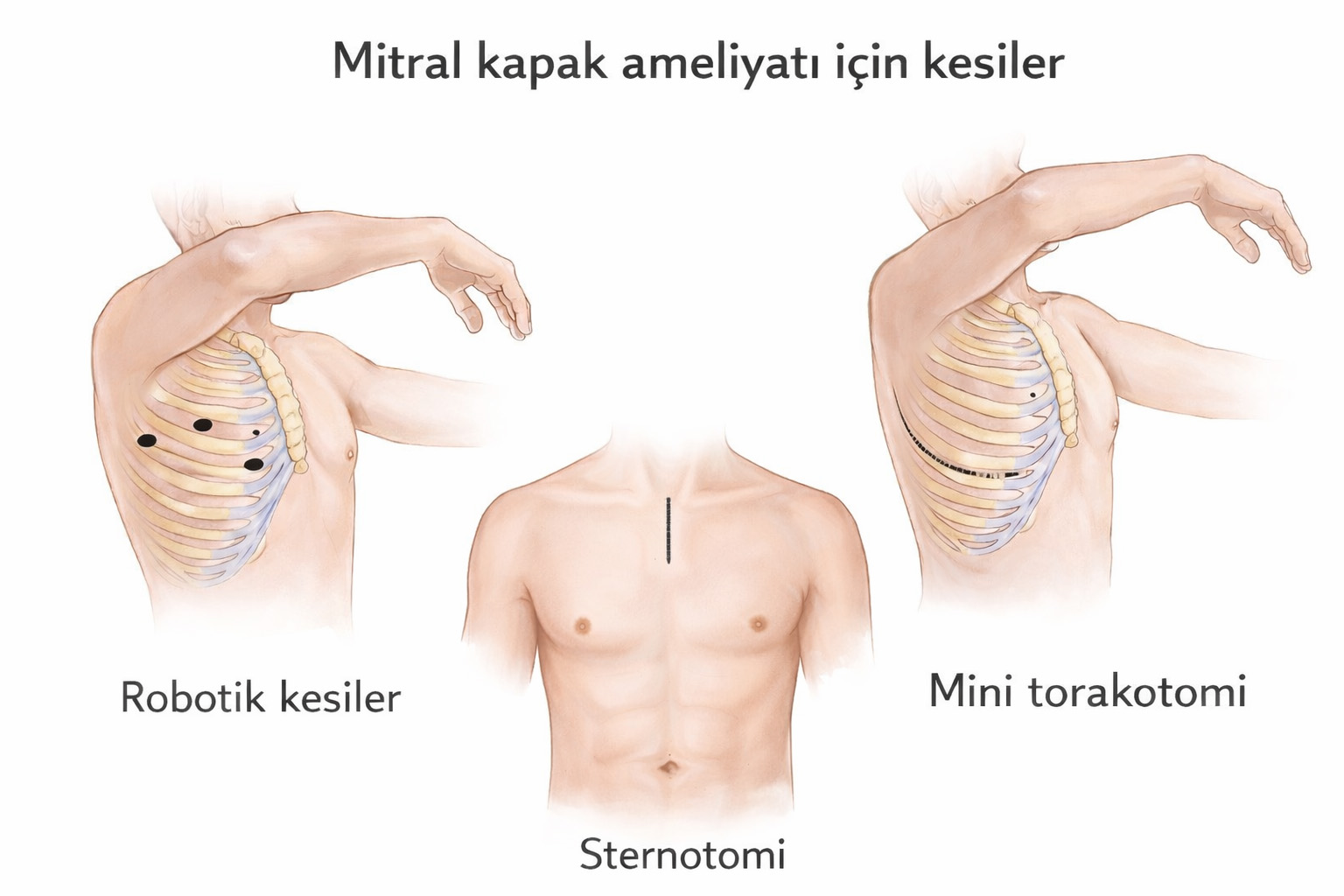 Mitral kapak ameliyatı kesileri