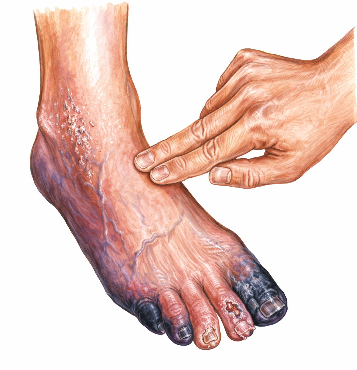 Periferik Damar Hastalığı