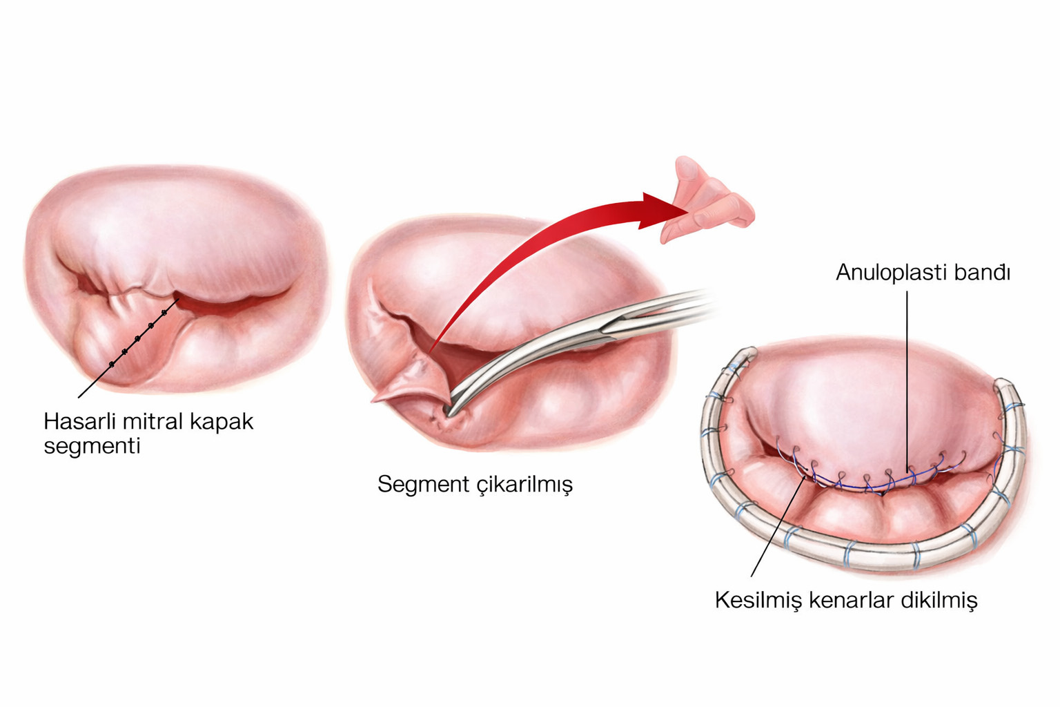 Mitral kapak tamiri illustrasyonu