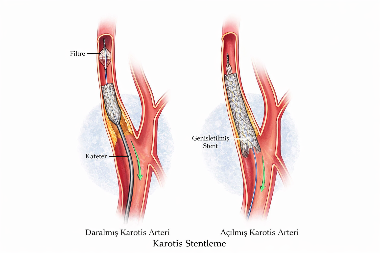 Karotis stentleme işlemi detayları