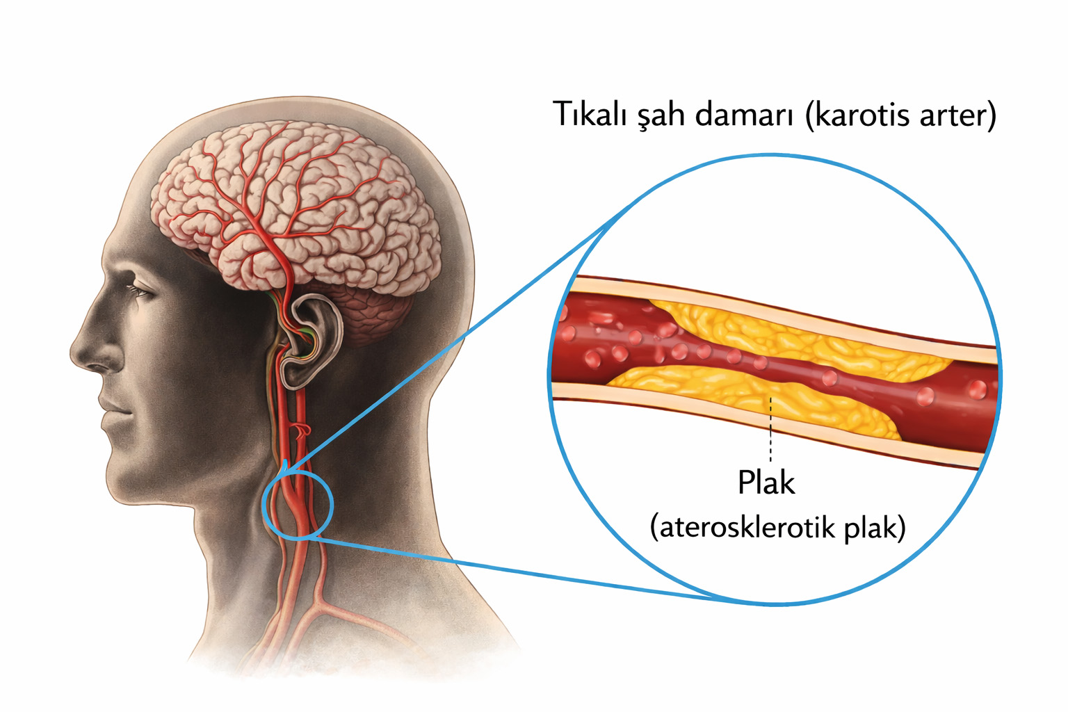 Karotis Arter Hastalığı