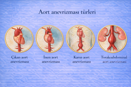 Aort anevrizması türleri: Asendan, Arkus, Torasik ve Abdominal anatomik yerleşim