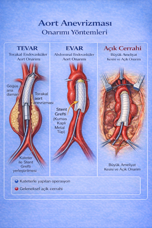 EVAR/TEVAR endovasküler yöntem — kasıktan girilerek aort içine stent-greft yerleştirilmesi